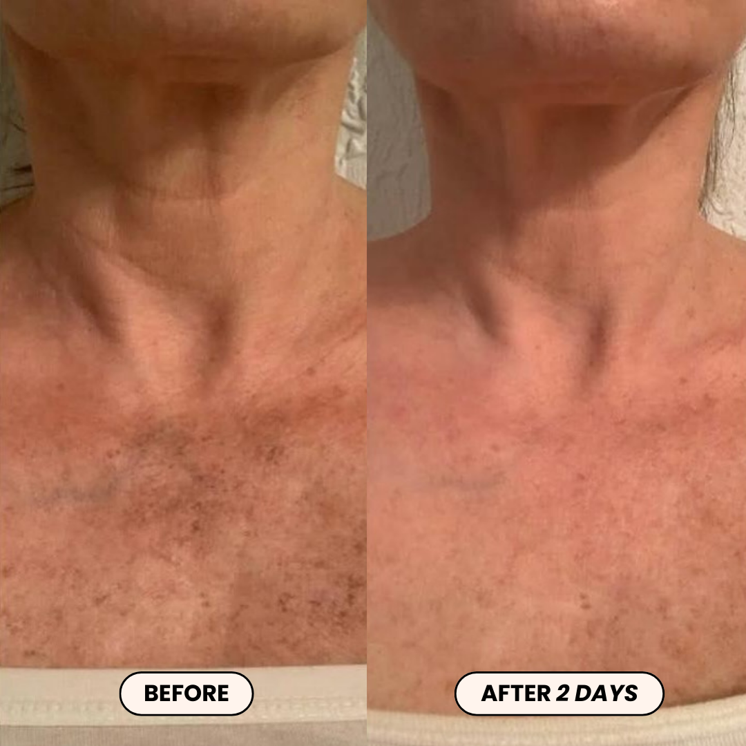 Dr. Melaxin PeelShot™ Kojic Acid & Turmeric Brightening Spray